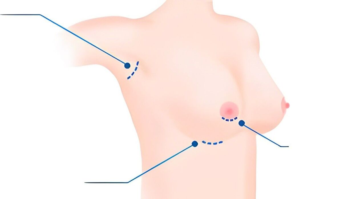 types of breast augmentation sizes